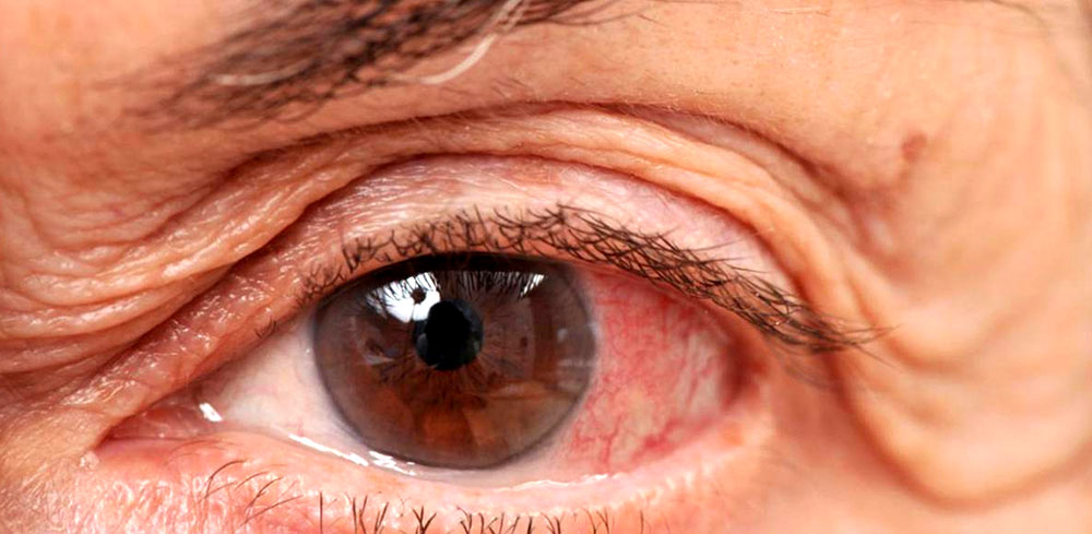 el-glaucoma-es-el-“ladron-silencioso-de-la-vision”-en-las-personas