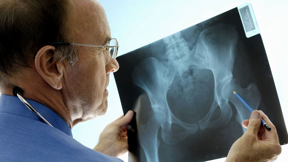 fracturas-por-osteoporosis-tienen-20%-de-chances-de-repetirse-en-el-ano